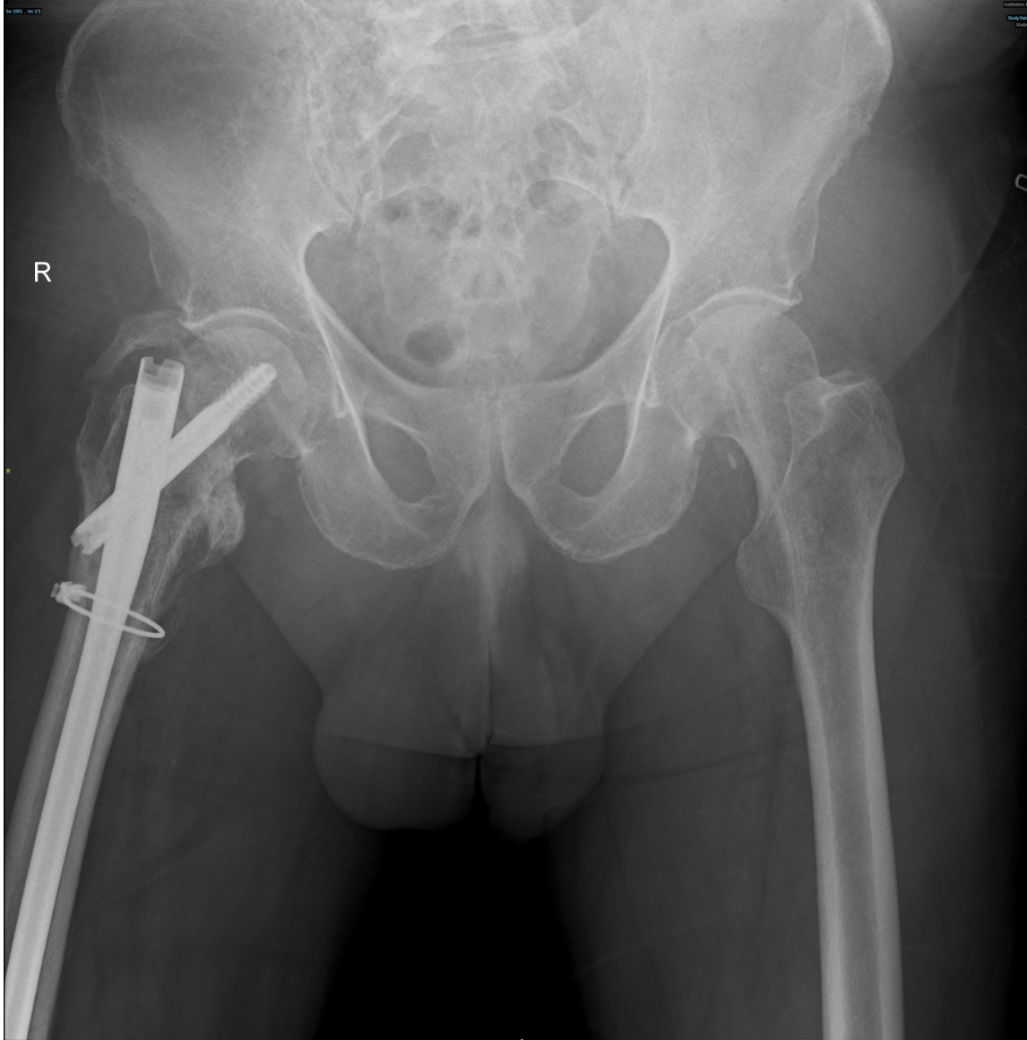 Post-op Post-op