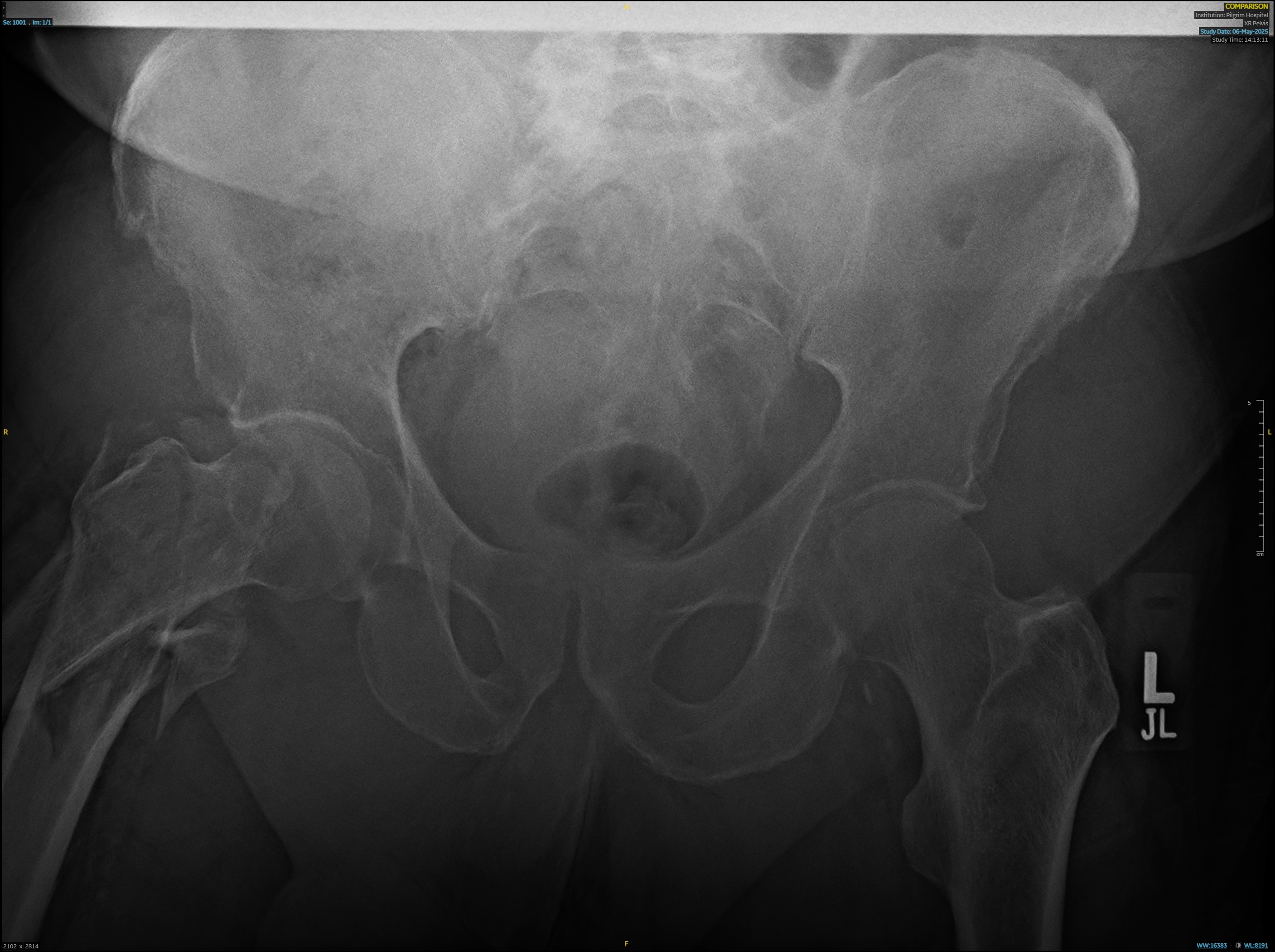 X-ray of Pelvis X-ray of Pelvis