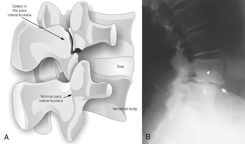Back Pain and Sciatica
