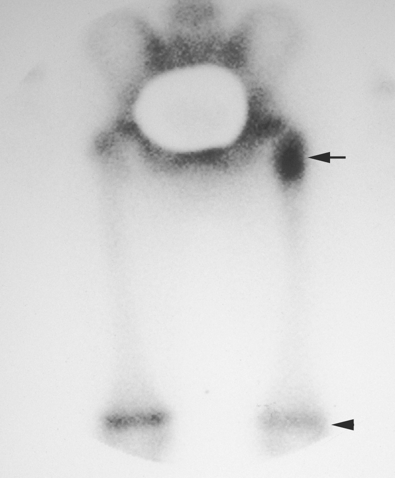 Bone and Soft-Tissue Tumors
