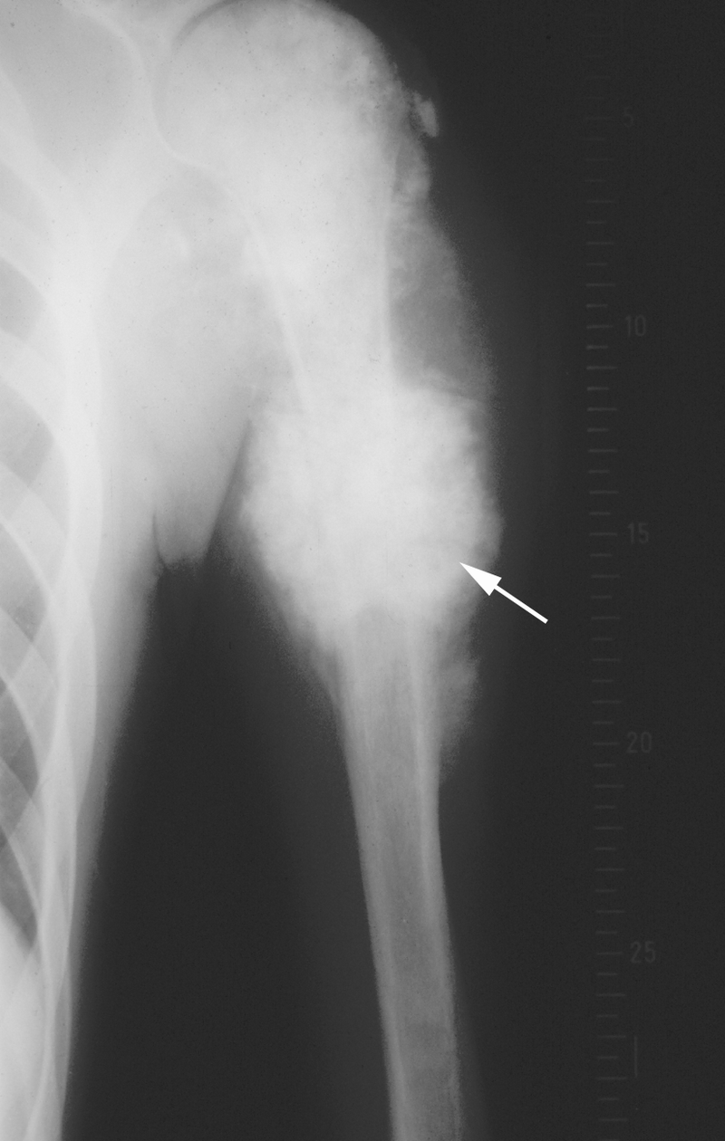 Bone and Soft-Tissue Tumors