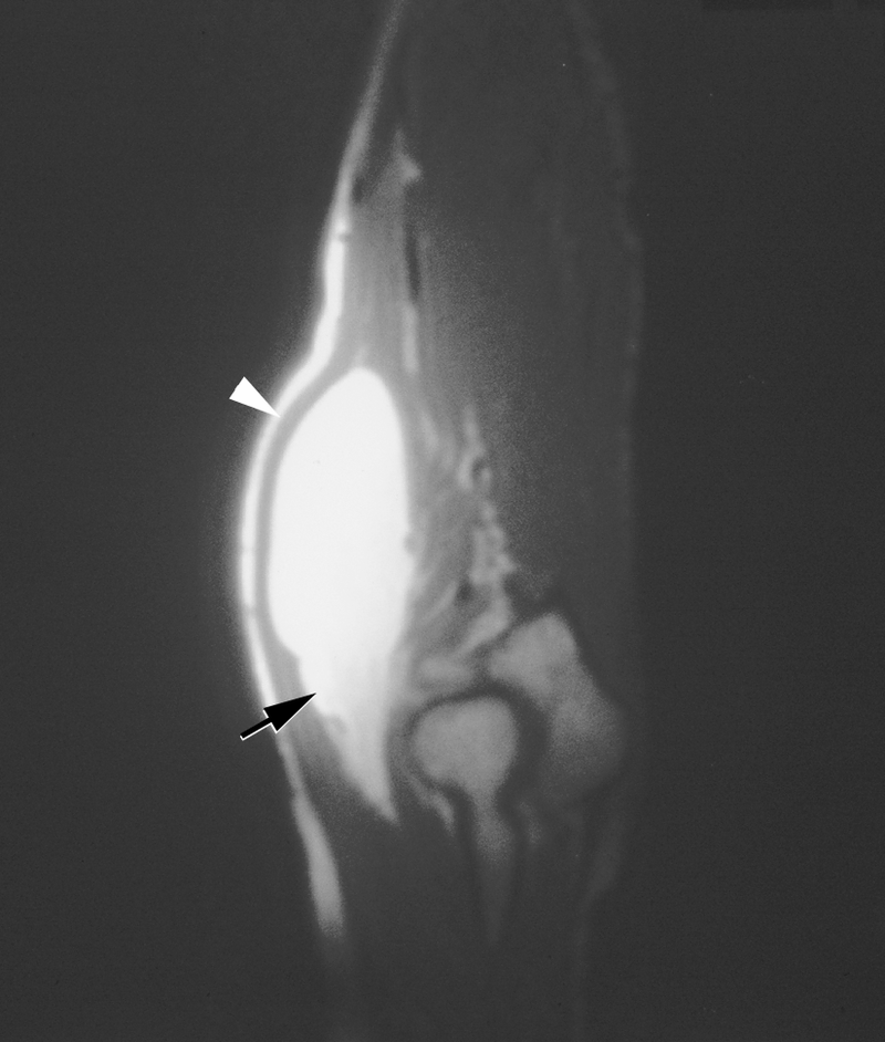 Bone and Soft-Tissue Tumors