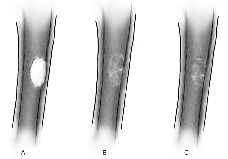Bone and Soft-Tissue Tumors