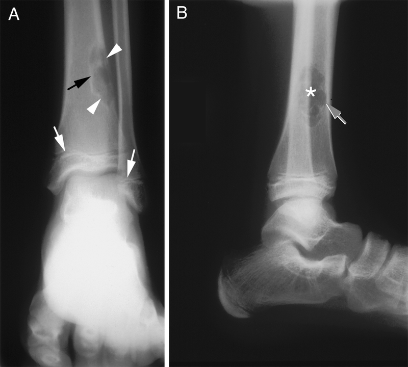 Bone and Soft-Tissue Tumors