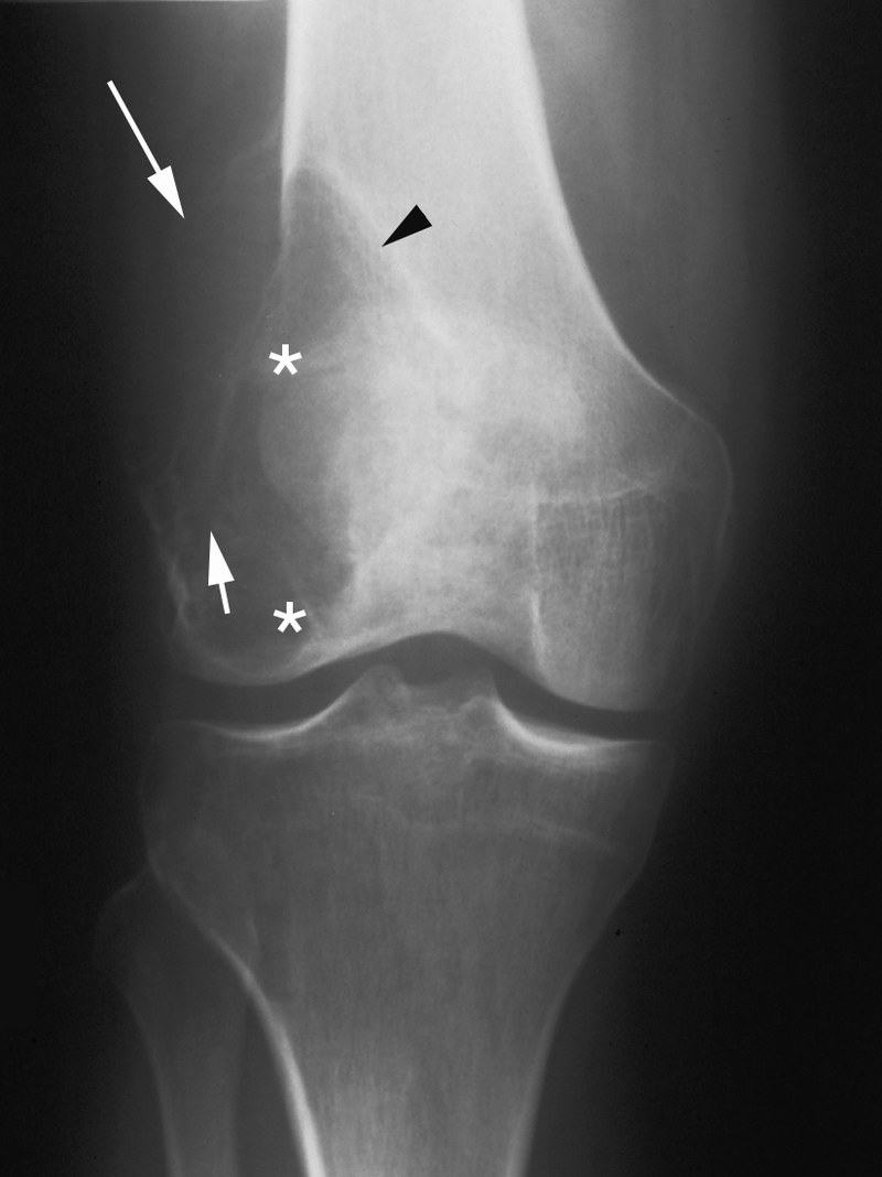 Bone and Soft-Tissue Tumors