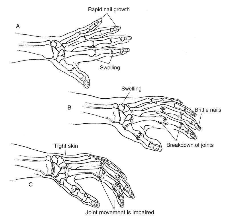 Chronic Pain Syndromes