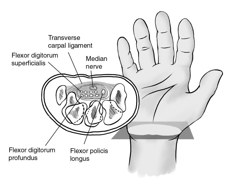 Compression Neuropathies