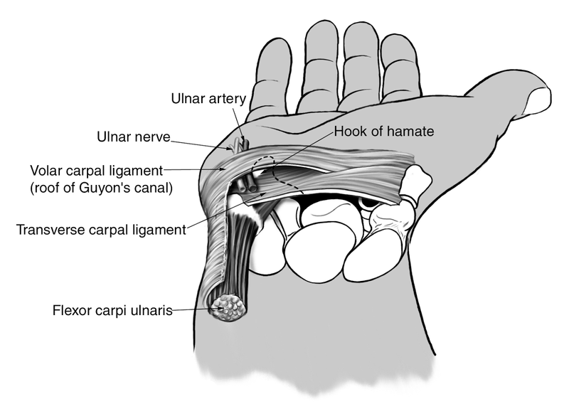 Compression Neuropathies