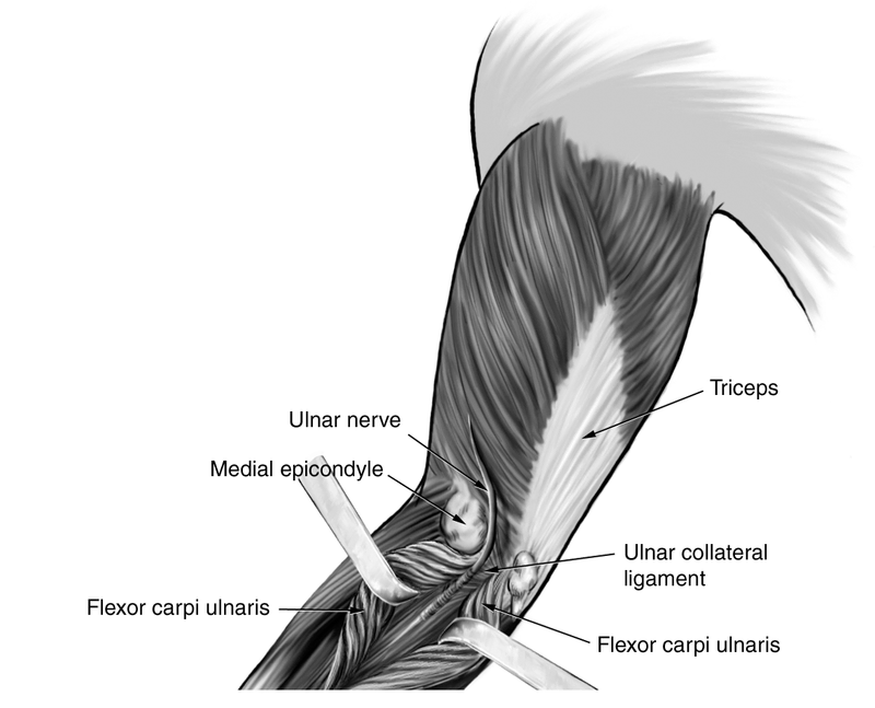 Compression Neuropathies