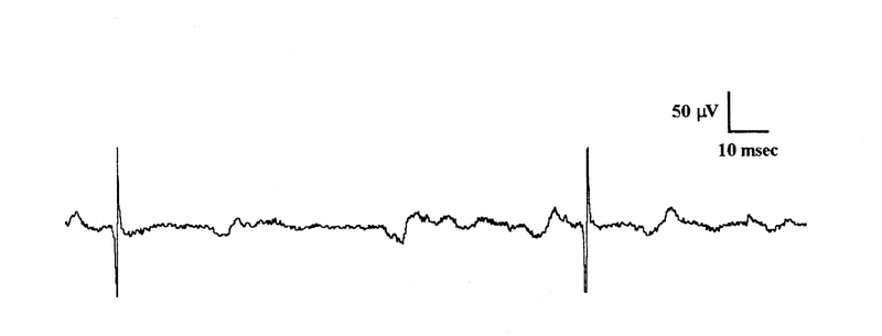 Electrodiagnostic Studies