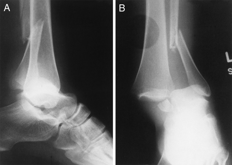 Fracture