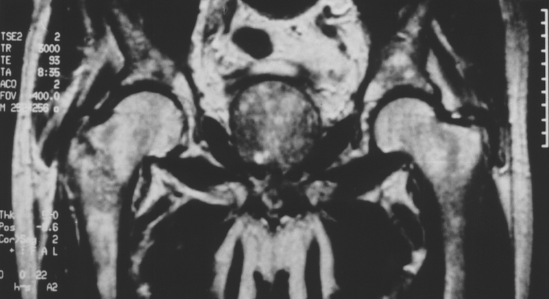 Fracture
