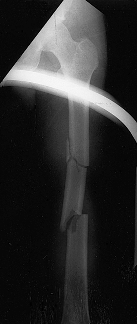 Fracture