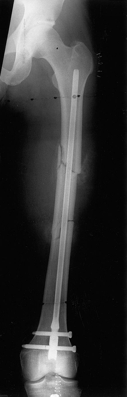 Fracture