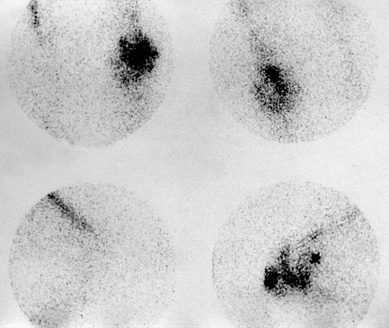 Infection