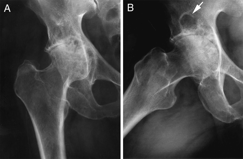 Inflammatory Arthritis