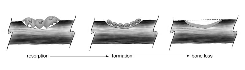 Metabolic Bone Disease