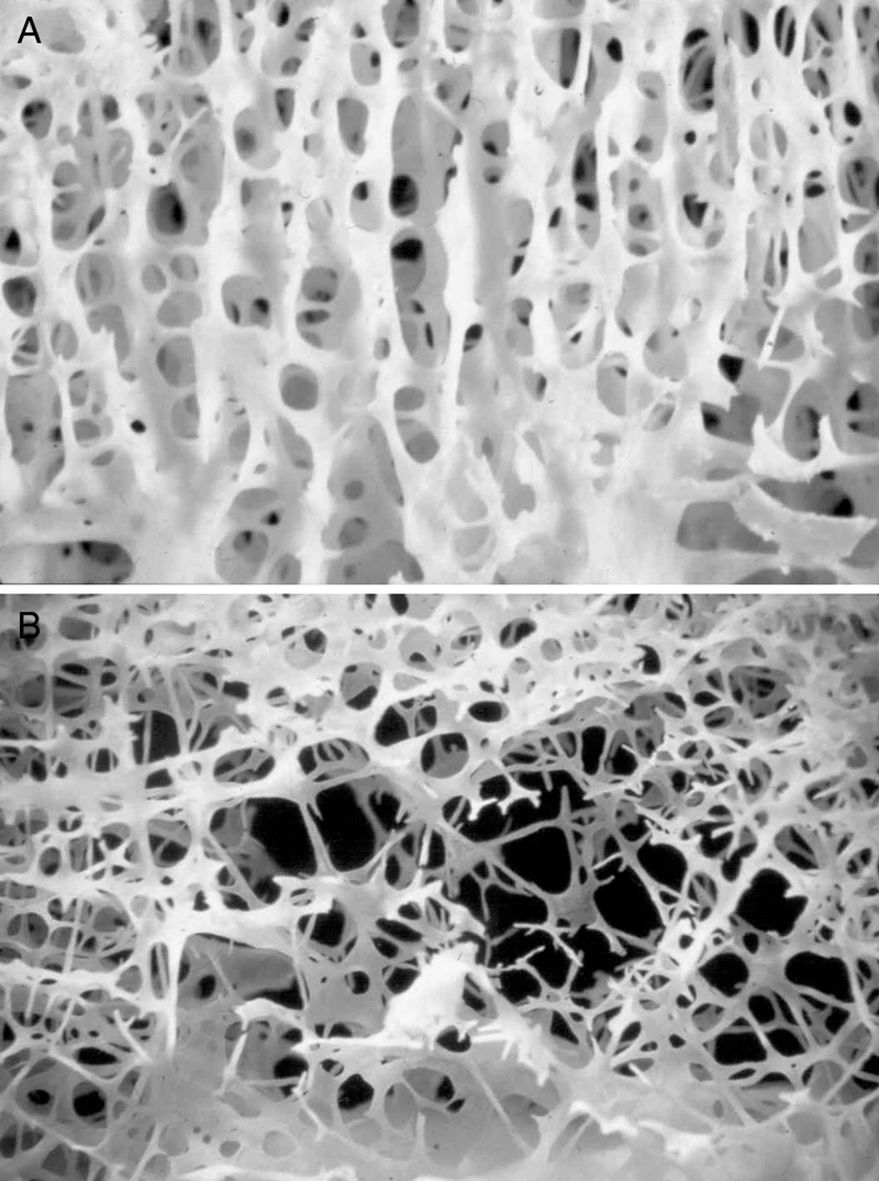 Metabolic Bone Disease