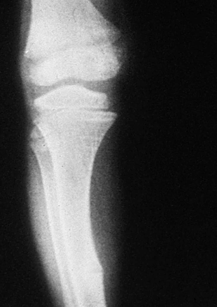 Metabolic Bone Disease
