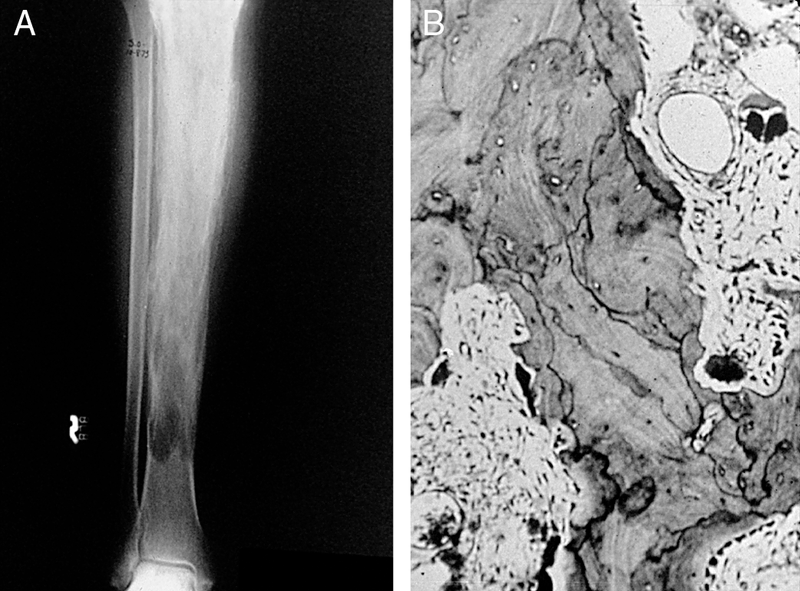 Metabolic Bone Disease
