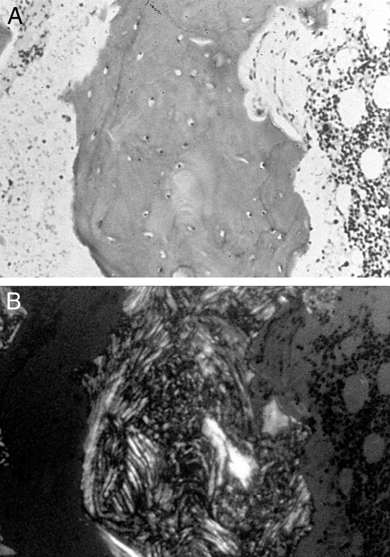 Metabolic Bone Disease