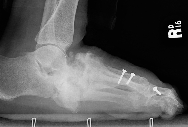 Osteoarthritis Osteoarthritis