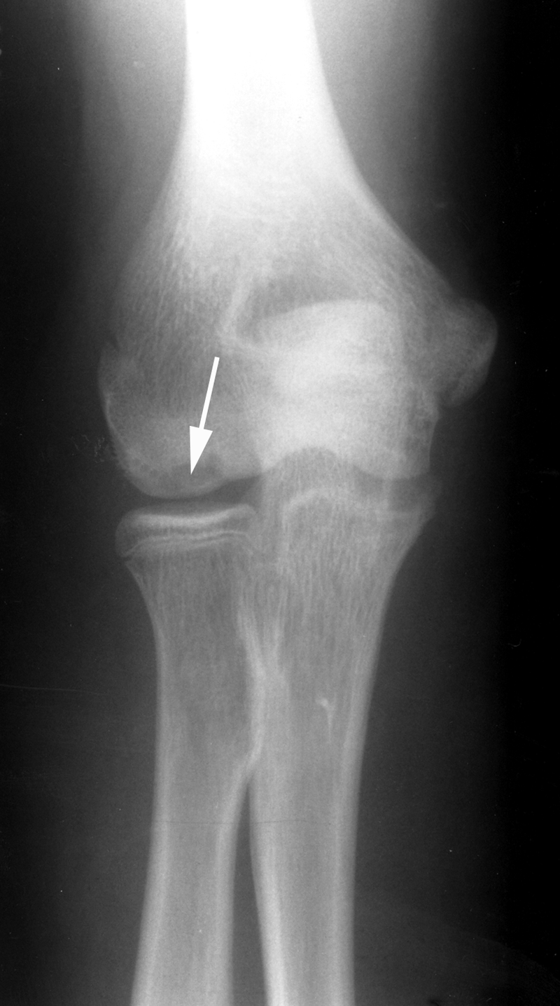Overuse Injuries