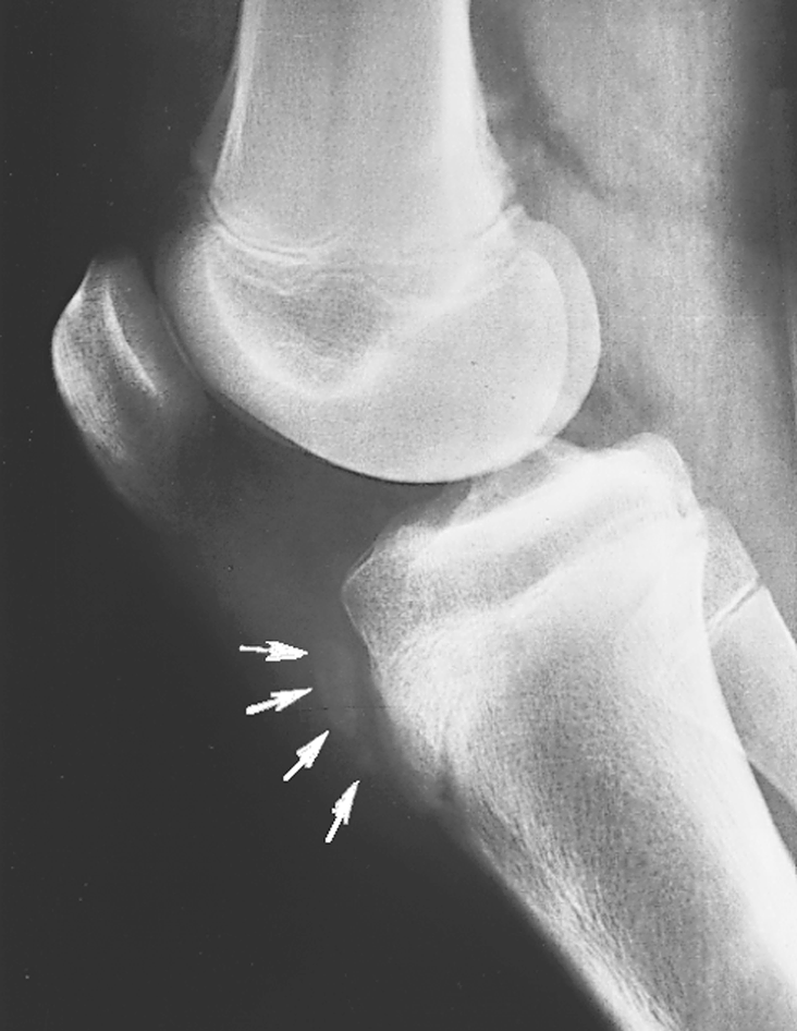 Overuse Injuries