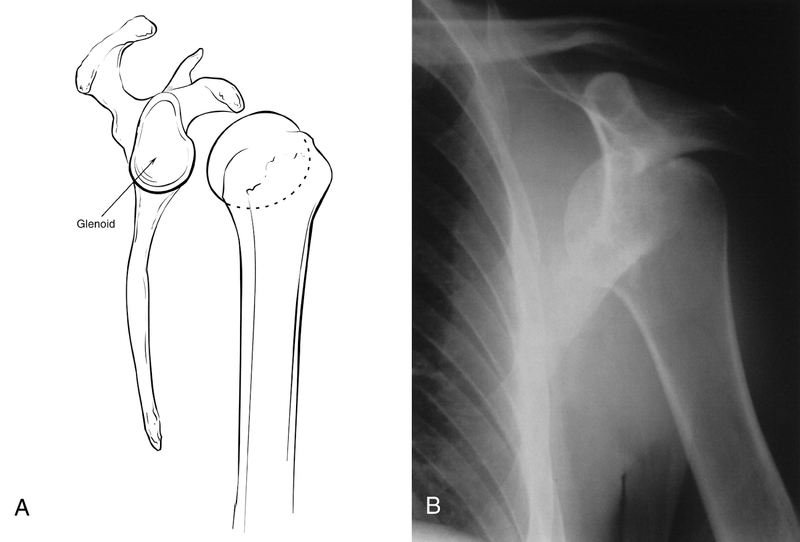 Soft-Tissue Trauma