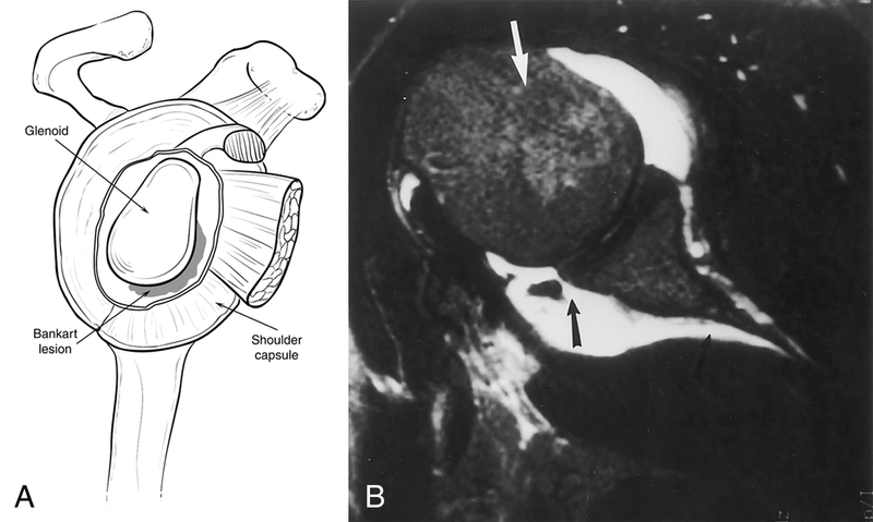 Soft-Tissue Trauma