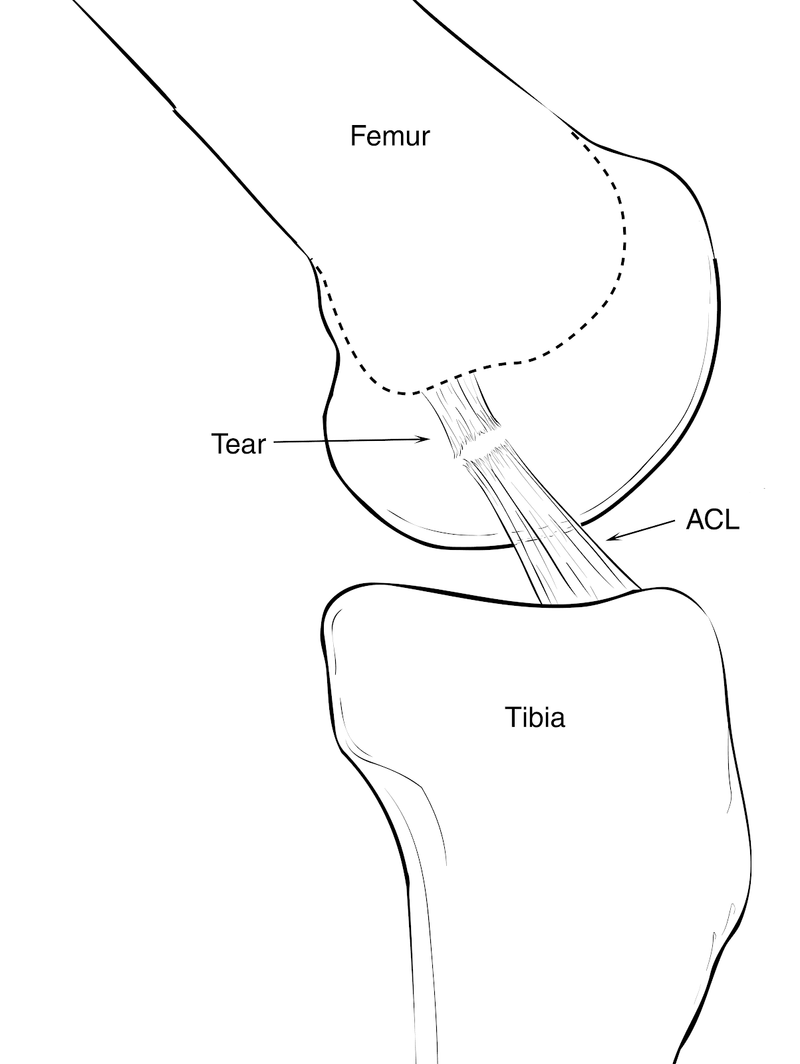 Soft-Tissue Trauma