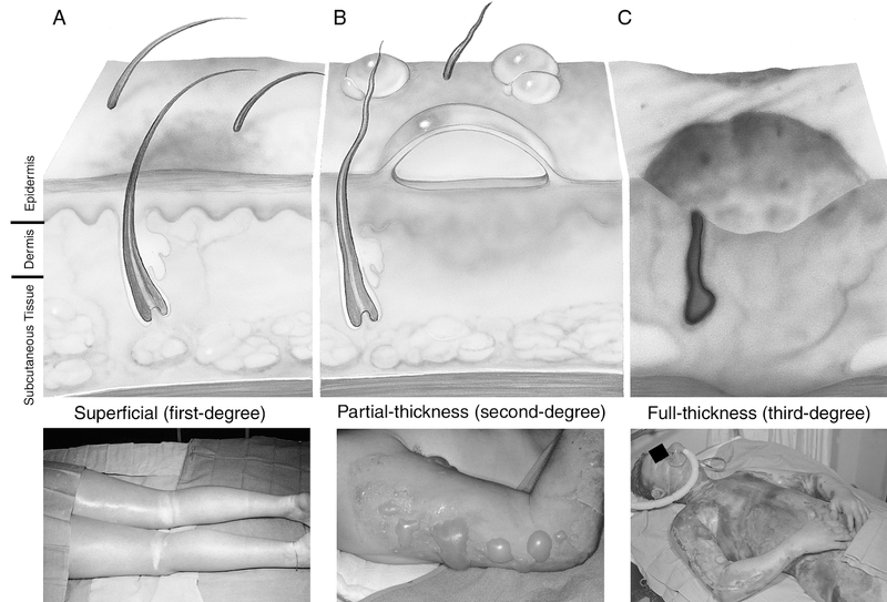 Soft-Tissue Trauma