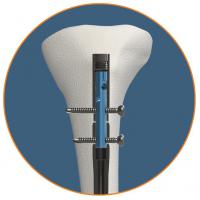 Apex Tibial Nailing System - OrthoXel