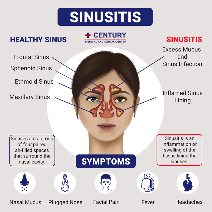 Sinusitis