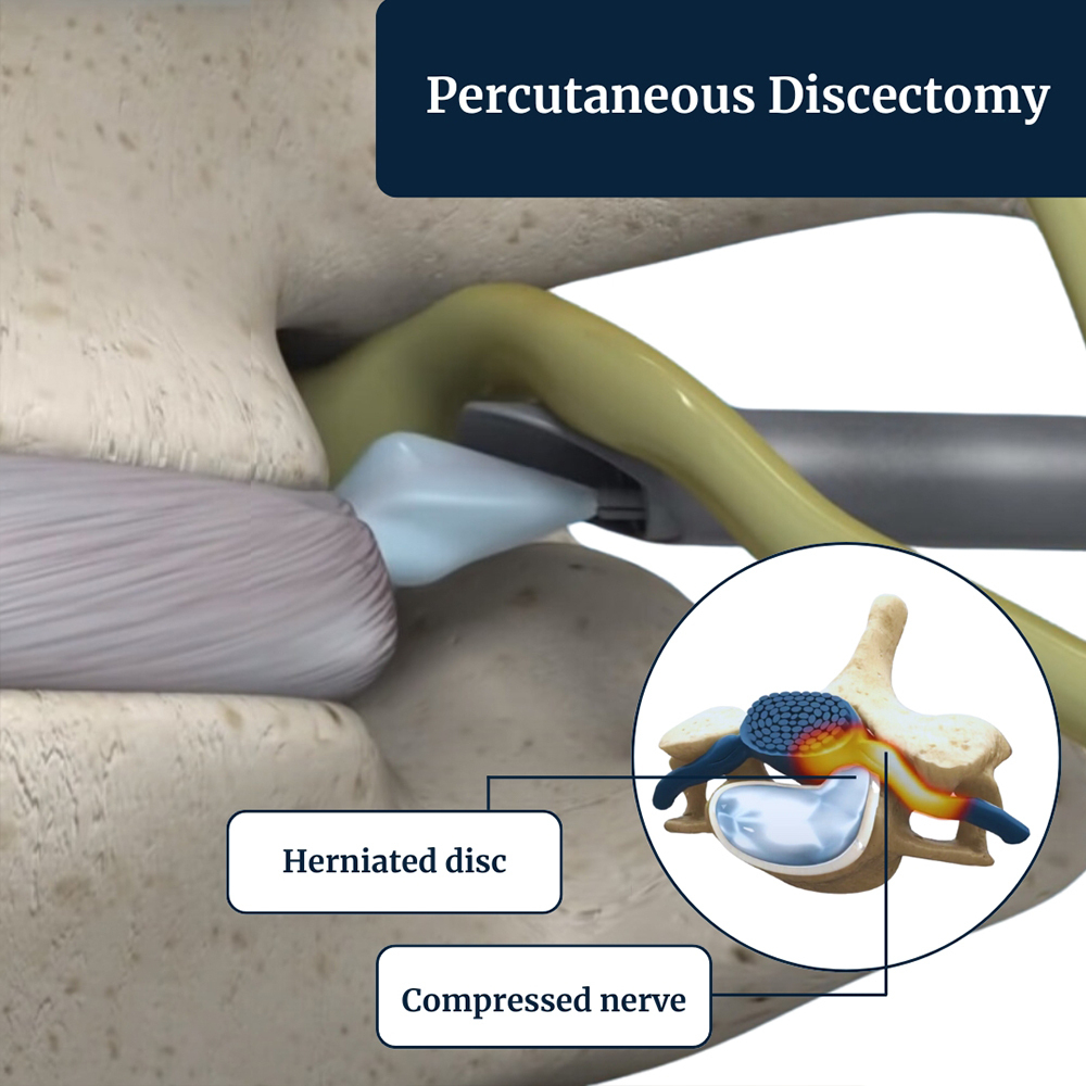 percutaneous-discectomy-procedure