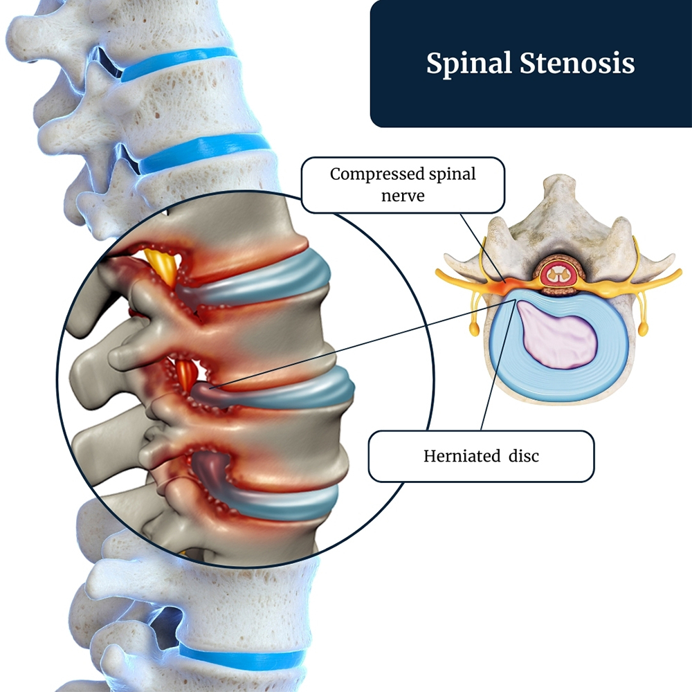 spinal-stenosis-treatment-irving-tx
