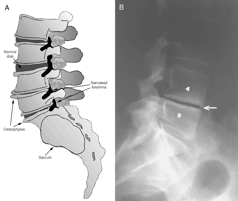 Back Pain and Sciatica