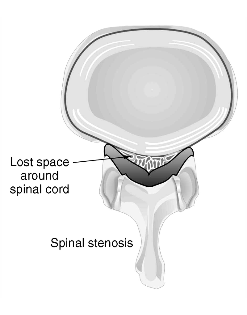 Back Pain and Sciatica