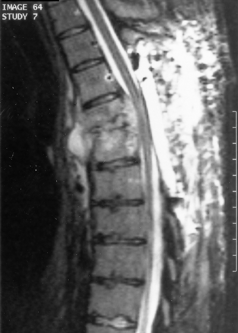 Back Pain and Sciatica