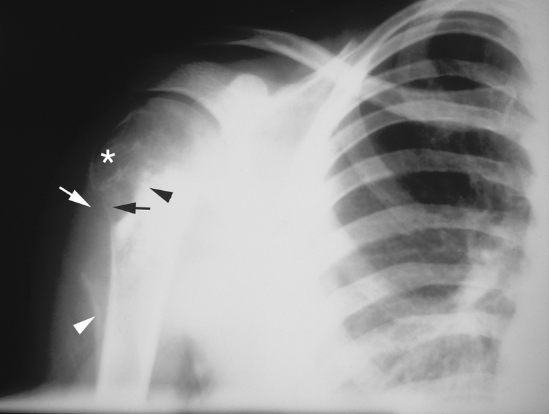 Bone and Soft-Tissue Tumors