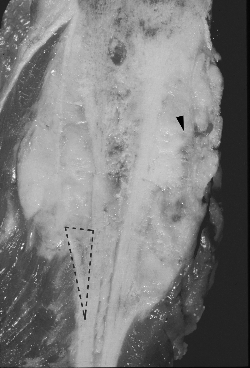 Bone and Soft-Tissue Tumors