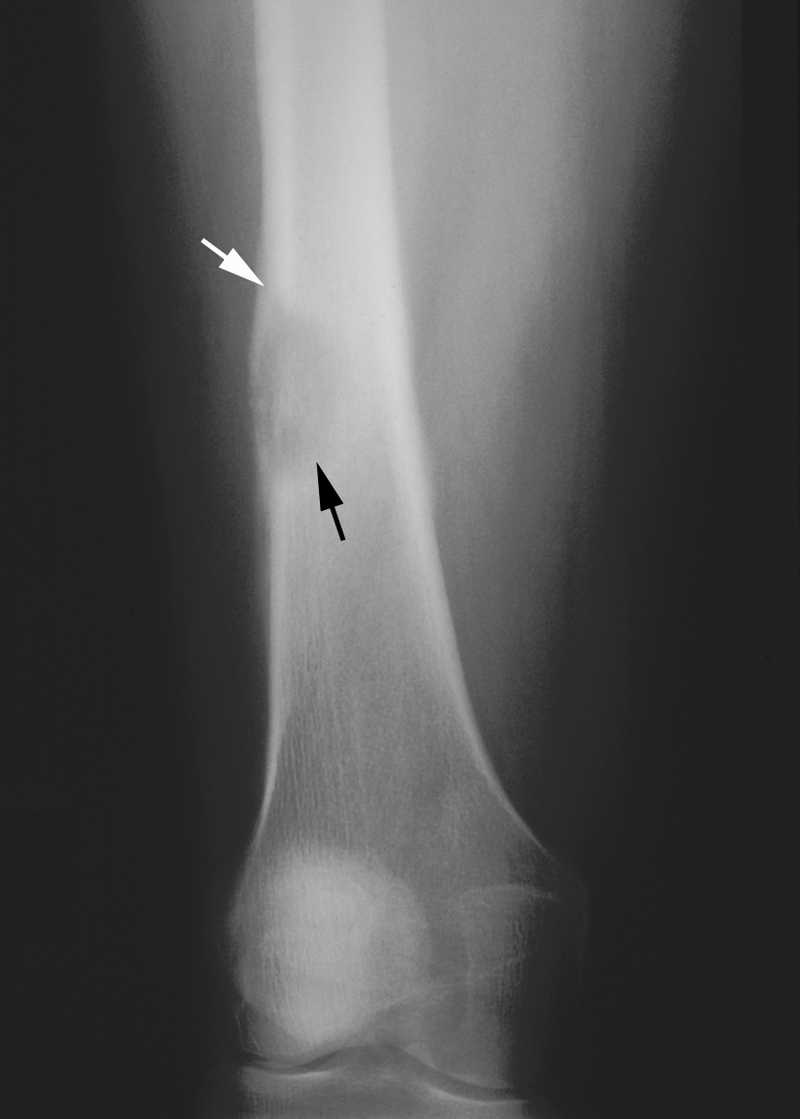 Bone and Soft-Tissue Tumors