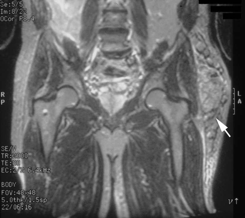Bone and Soft-Tissue Tumors