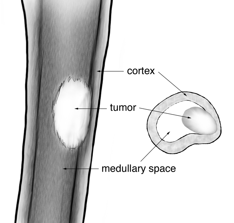 Bone and Soft-Tissue Tumors