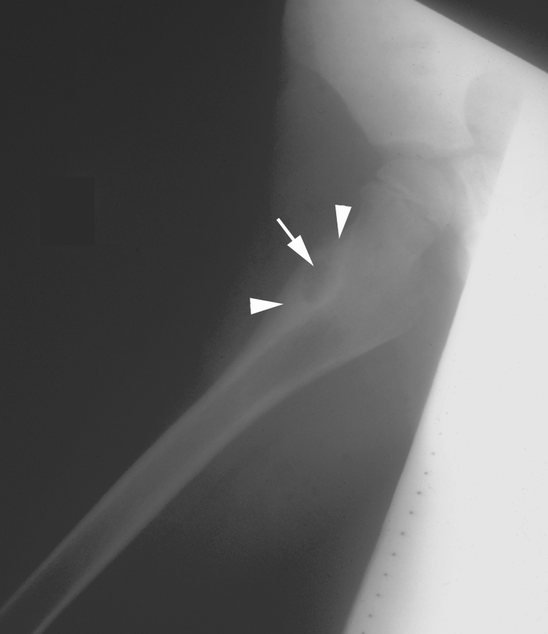 Bone and Soft-Tissue Tumors