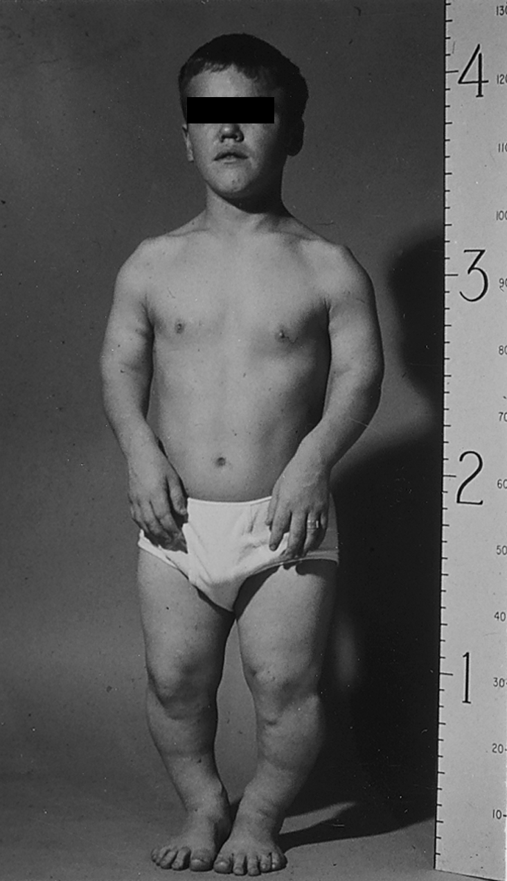 Disorders of Musculoskeletal Growth and Development
