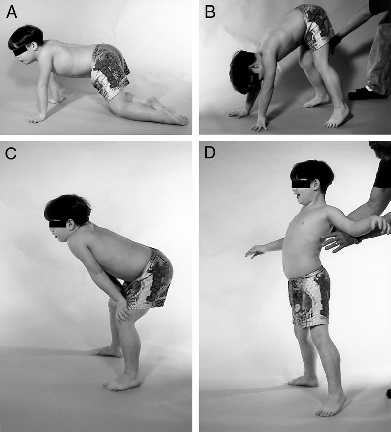 Disorders of Musculoskeletal Growth and Development