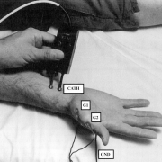 electrodiagnostic-studies