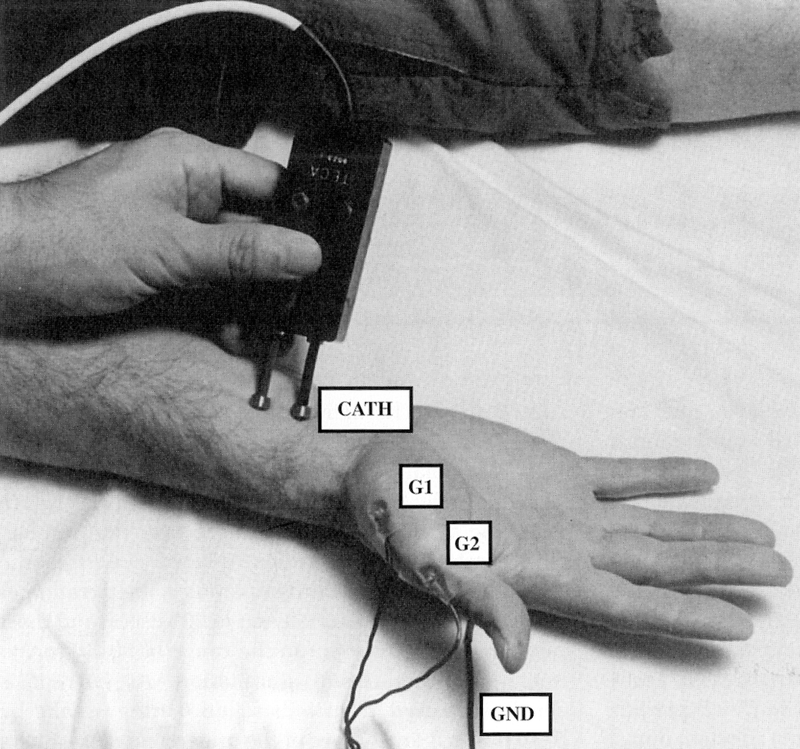 Electrodiagnostic Studies