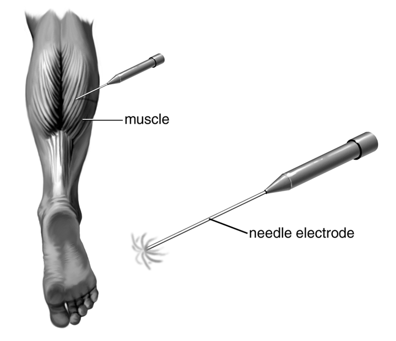 Electrodiagnostic Studies